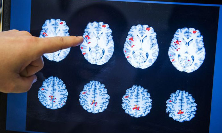 Lisboa recebe 80 peritos mundiais na doença de Alzheimer