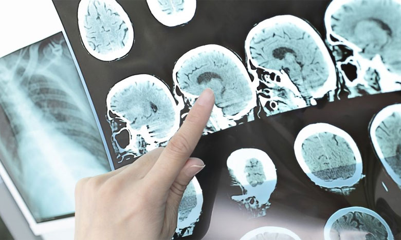 Neurociências saúdam descoberta de Egas Moniz que permite reverter AVC