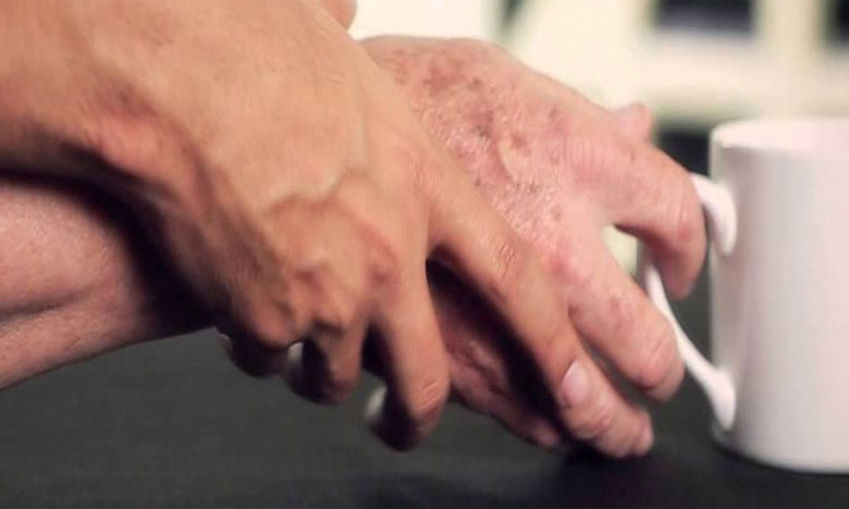 Novo fármaco português para Parkinson lançado na Alemanha e Reino Unido