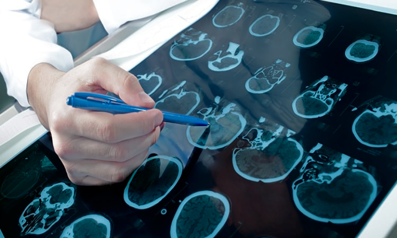 Portugueses desenvolvem técnica que reduz riscos na remoção de tumores cranianos