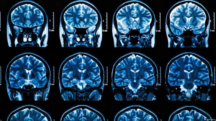 Cientistas portugueses identificam região cerebral com potencial de alteração precoce por Alzheimer 11 Cientistas portugueses identificam região cerebral com potencial de alteração precoce por Alzheimer